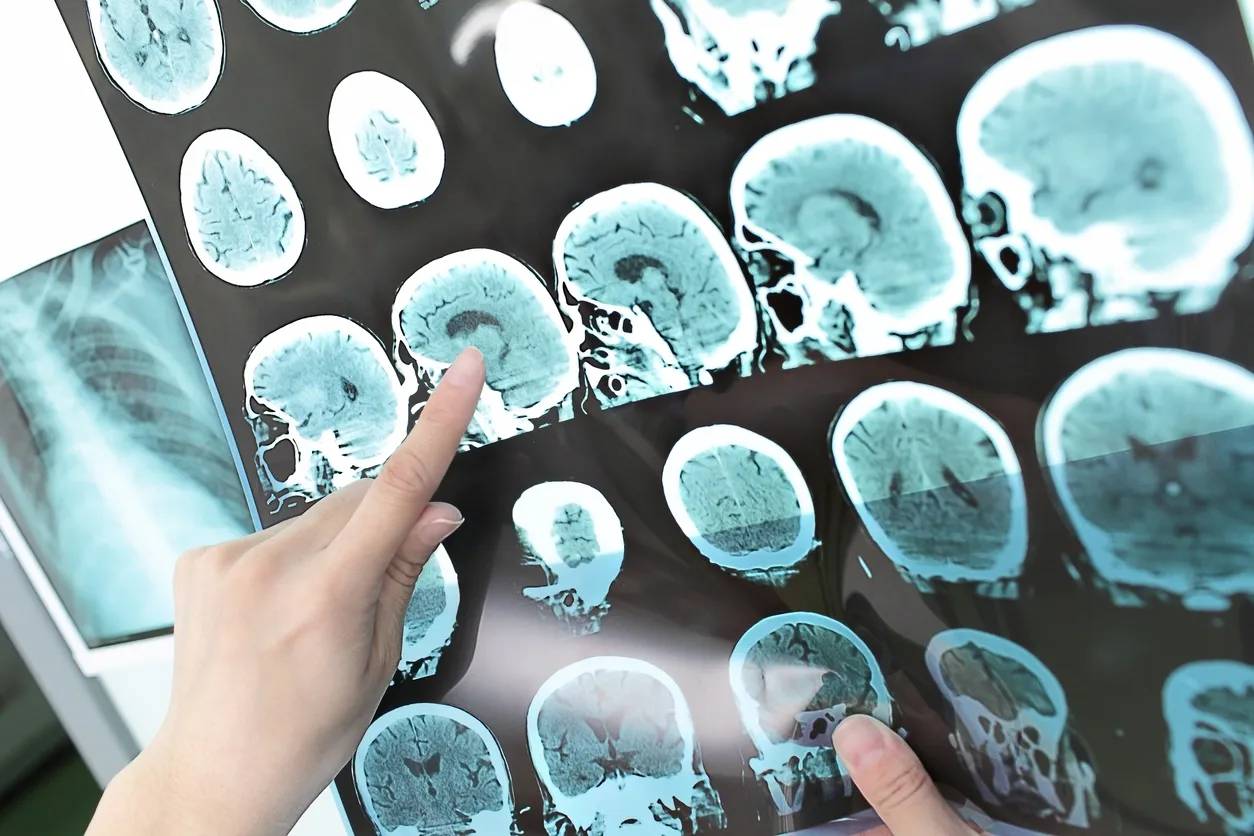 A person pointing to a brain damage on a brain xray report