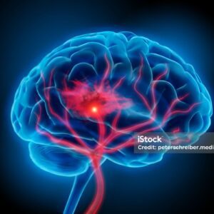 Illustration of human brain with stroke symptom