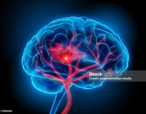 Illustration of human brain with stroke symptom